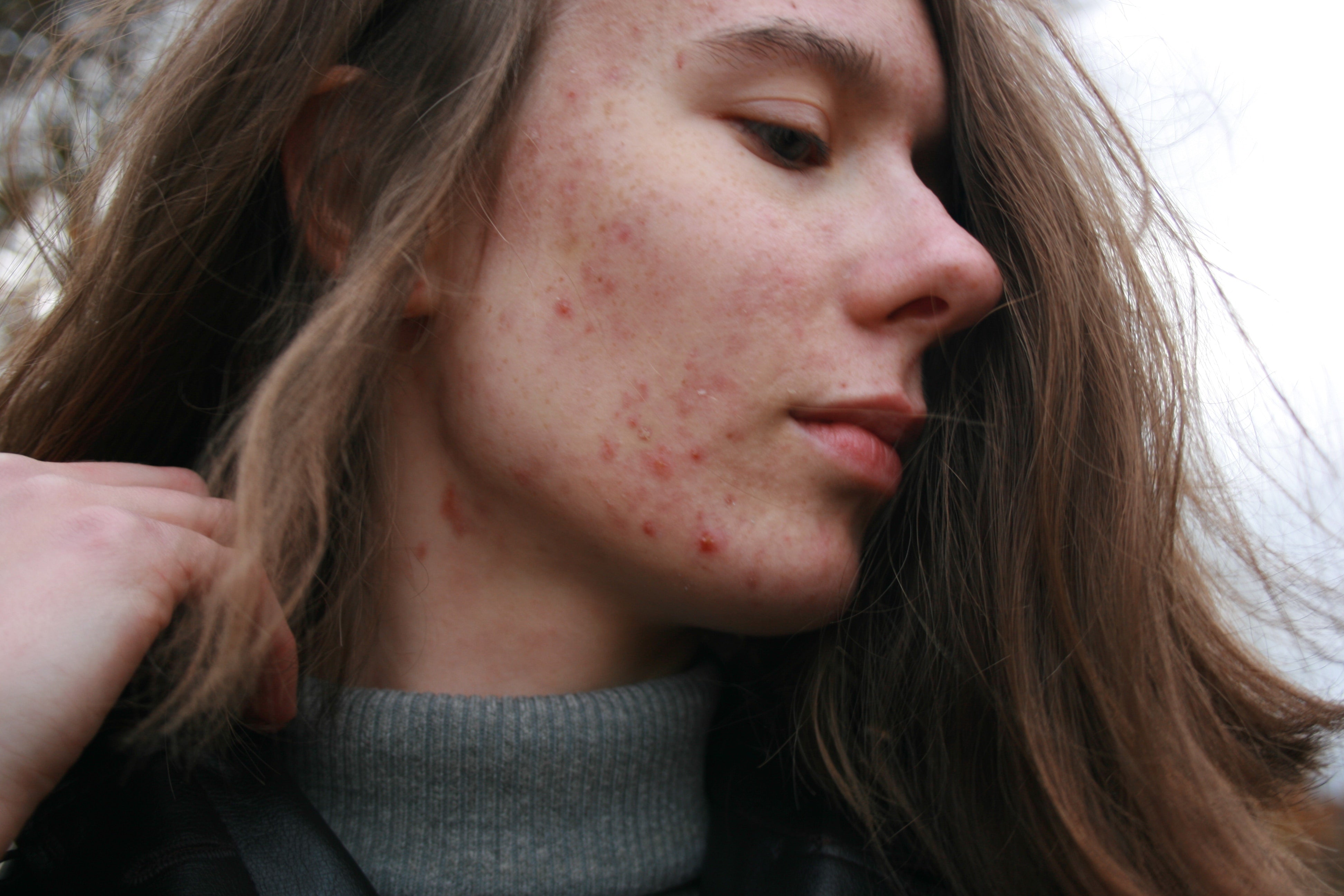 Definitive Guide for Choosing the Right Acne Treatment for Your Skin