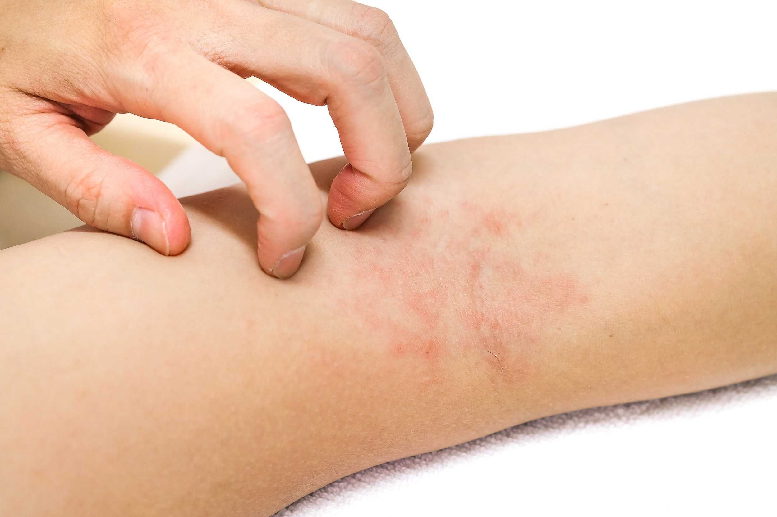 Inflammatory Skin Conditions: Causes, Symptoms, and Treatments