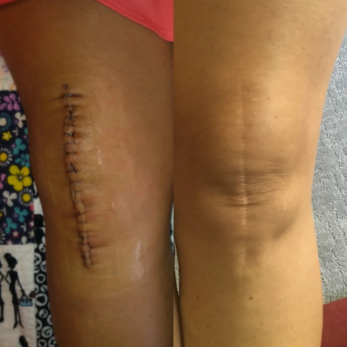 Knee Replacement Scars: A Comprehensive Guide to Healing and Care