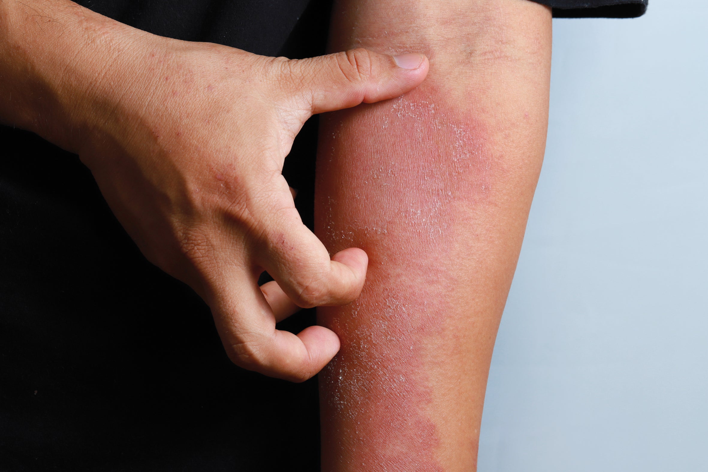Psoriasis vs. Eczema: The Differences, Symptoms, and Treatments