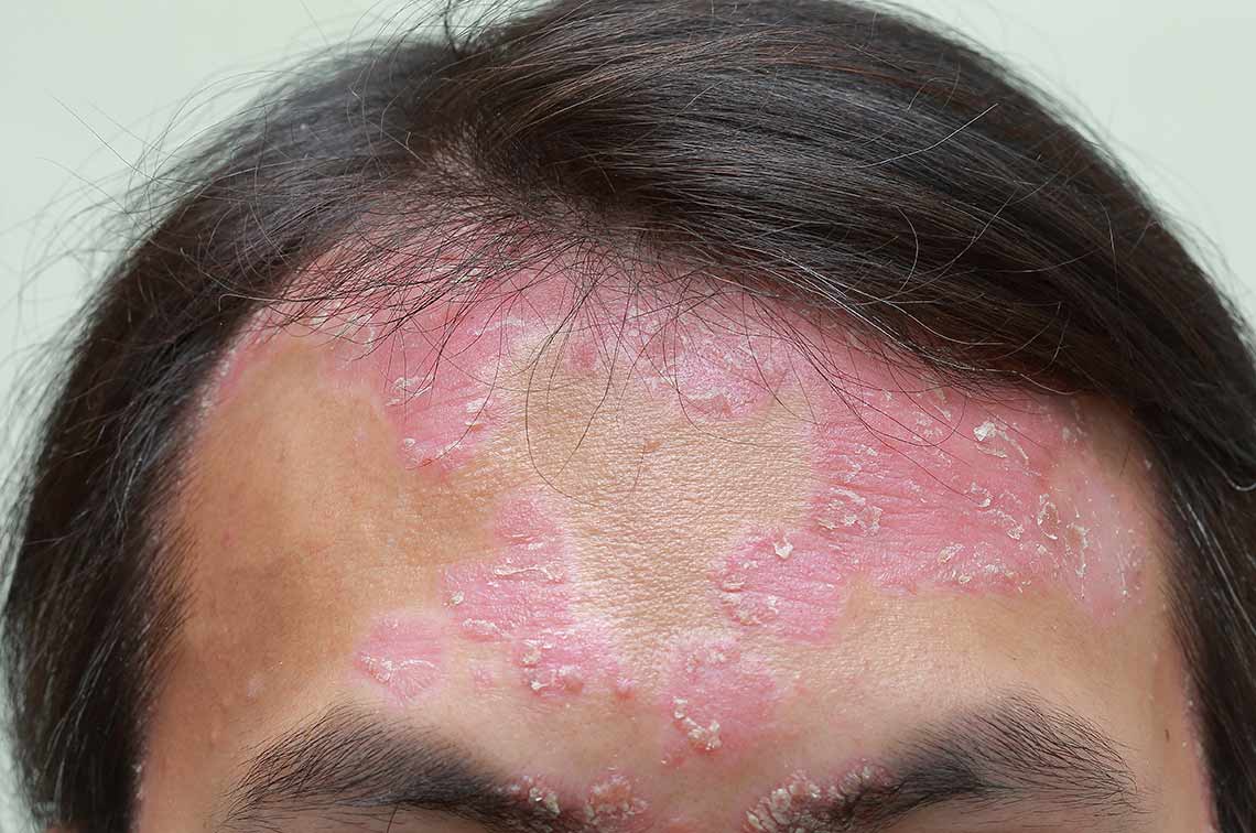 Psoriasis on Face: Understanding, Managing, and Treating