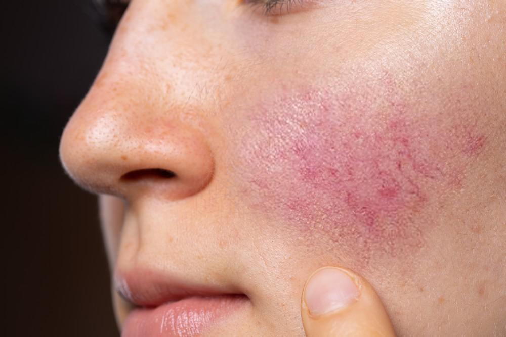 Self-Care Rosacea Treatments: A Guide to Managing and Clearing Skin