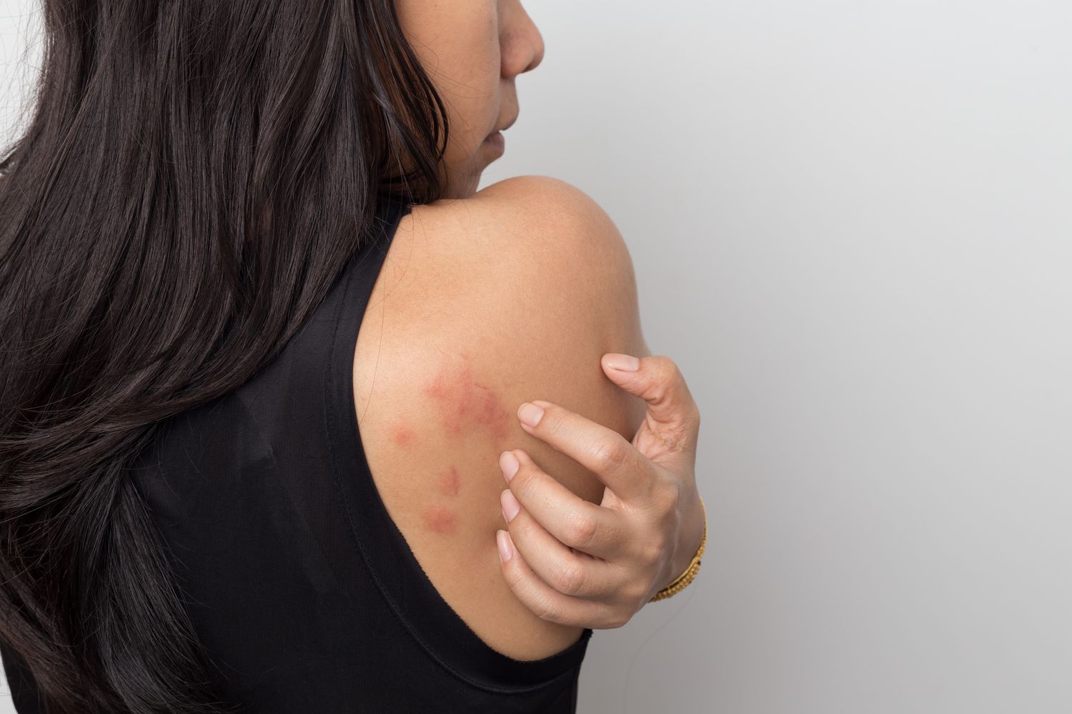 Stress Hives: Understanding, Managing, and Preventing This Reaction