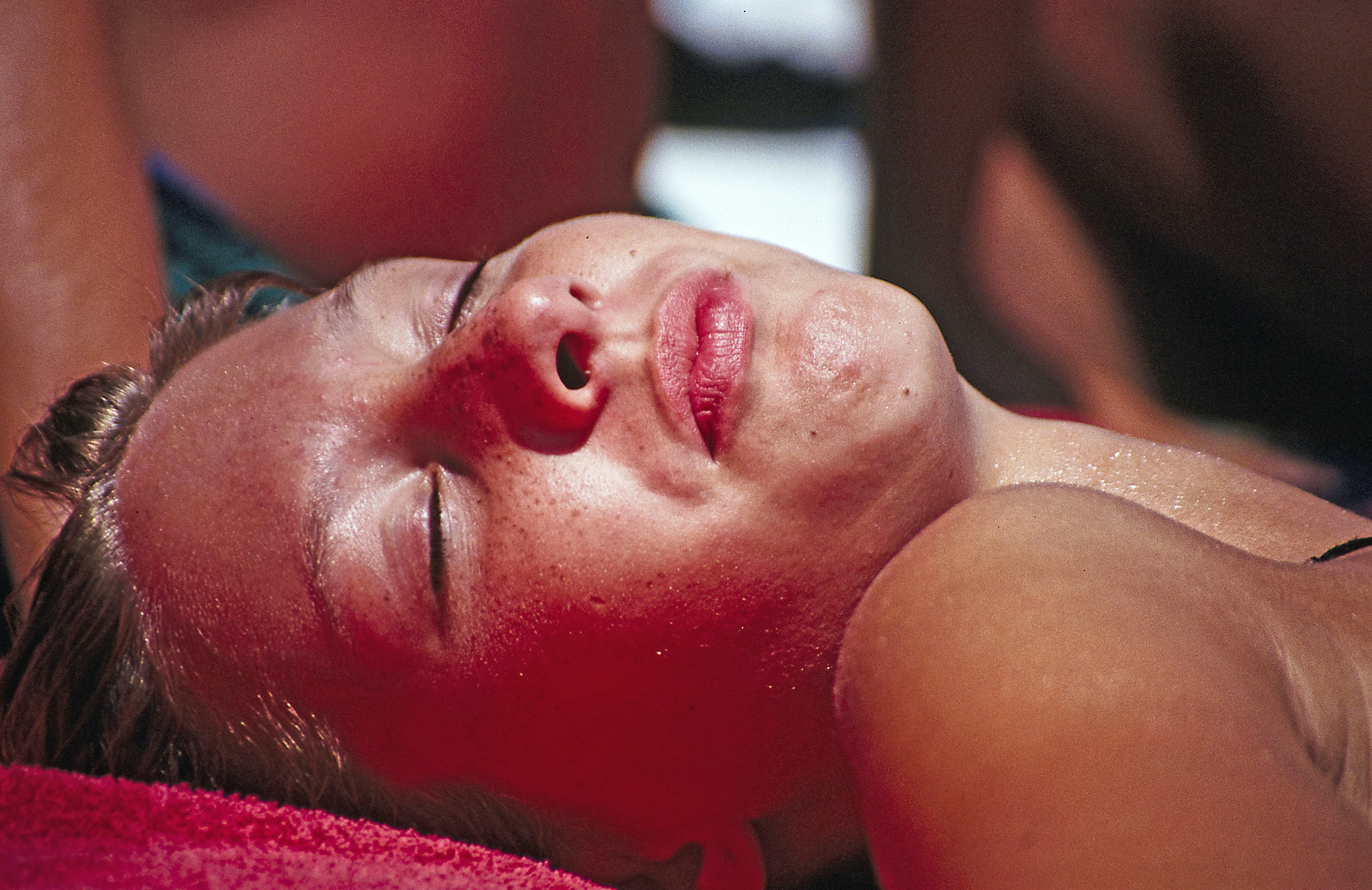 Severe Sunburn: How Long Does It Last? Treatment and Prevention
